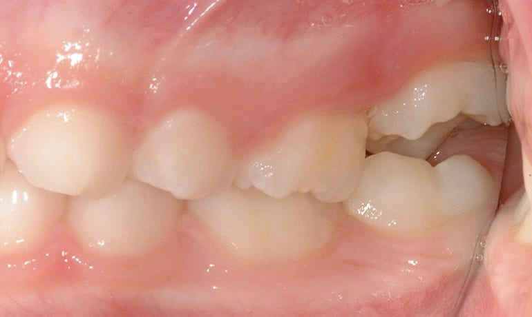 Ectopic-teeth-091463-PostRx_20-web