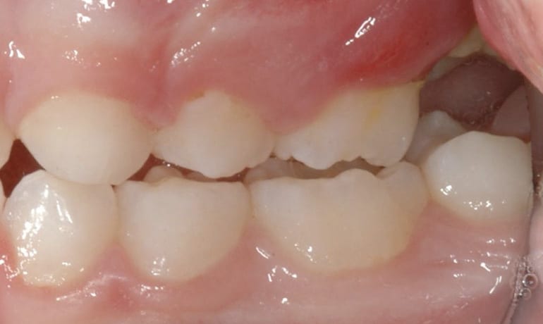 Ectopic-teeth-091463-PreRx_2-web